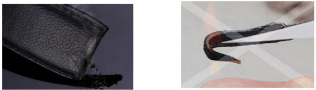 That lung nam Ngoc Quang phan biet da khi bi dot chay duoi lua that lung khoa tu dong | thatlungnam.com.vn